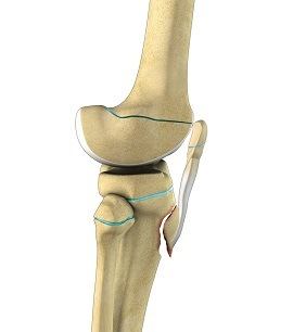 Pediatric Tibial Tubercle Fractures pic