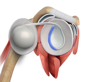 Posterior Shoulder Labral Repair pic