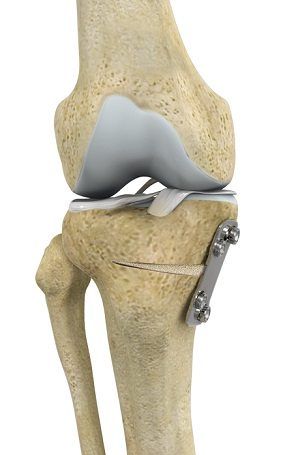 Proximal Tibial Osteotomy pic