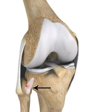 Proximal Tibiofibular Joint Instability pic