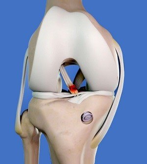 Revision ACL Surgery pic