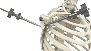 Revision Open Labral Repair (Revision Bankart) pic