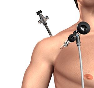 Shoulder Arthroscopy pic