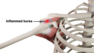 Shoulder Bursitis pic
