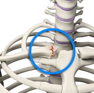 Sternoclavicular Joint (SC joint) Disorders pic