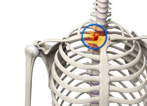 Sternoclavicular(SC) Joint Injuries pic