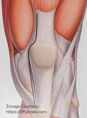 Traditional Knee Exposure Img