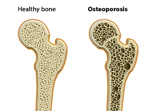 Osteoporosis