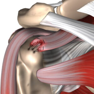 Rotator Cuff Repair
