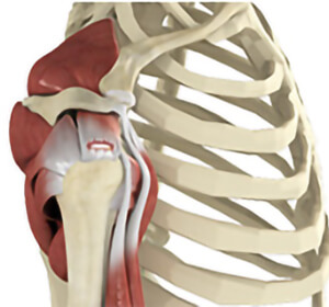 Rotator Cuff Tear