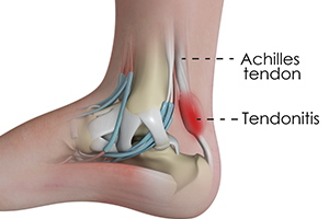 Achilles Tendonitis Icon