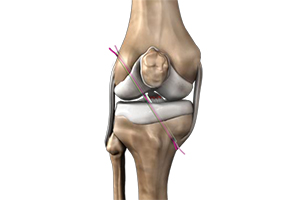 ACL Reconstruction Icon