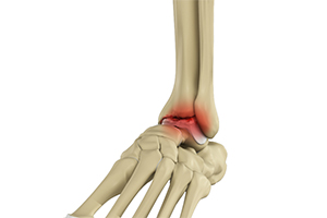 Ankle Arthritis Icon