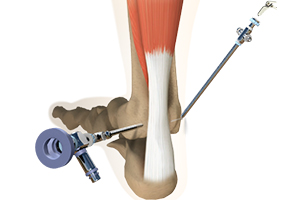 Ankle Arthroscopy Icon