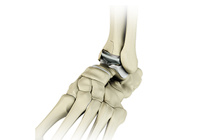 Ankle Joint Replacement Icon