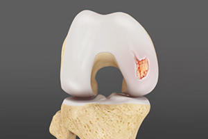 Articular Cartilage Injury (Knee) Icon