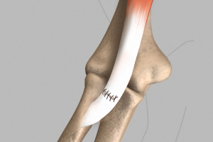 Biceps Tendon Repair Icon