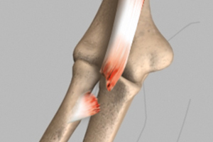 Biceps Tendon Tear at the Shoulder Icon