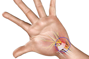 Carpal Tunnel Syndrome Icon