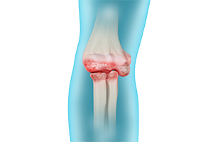 Elbow Arthritis Icon