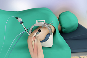 Elbow Arthroscopy Icon