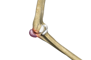 Elbow (Olecranon) Bursitis Icon
