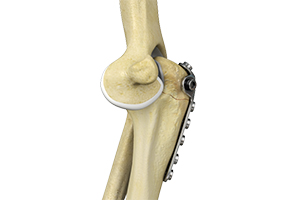 Elbow Fracture Reconstruction Icon