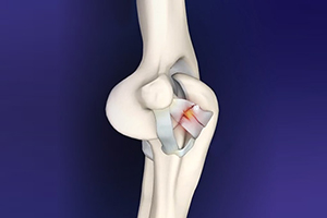 Elbow Ligament Reconstruction Icon