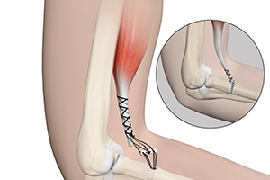 Elbow Tendon and Ligament Repair Icon