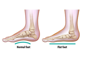 Flatfoot Reconstruction Icon