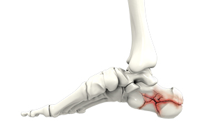 Foot Fracture Icon