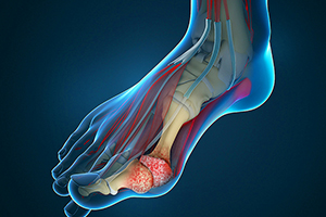 Hallux Rigiditis Icon