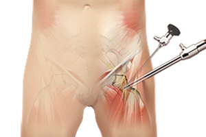 Hip Arthroscopy Icon