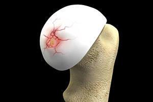 Hip Cartilage Repair Icon