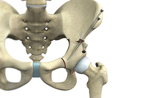 Hip Preservation Surgery Icon