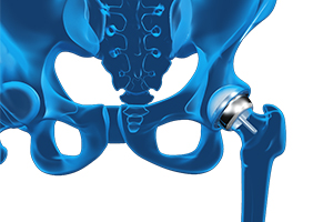 Hip Resurfacing Icon