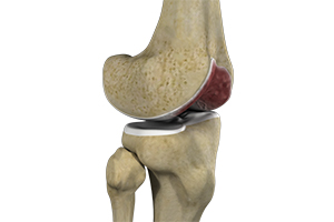 Knee Arthritis Icon