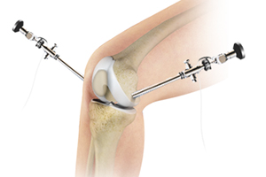 Knee Arthroscopy Icon