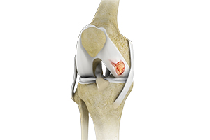Knee Cartilage Restoration Icon