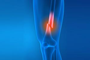 Knee Fracture Icon