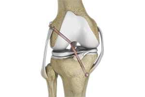 Knee Ligament Reconstruction Icon
