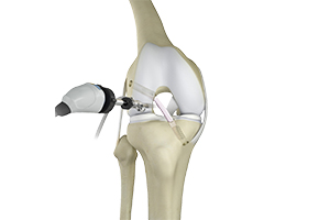 Knee Trauma Reconstruction Icon