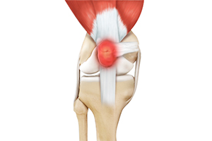 Kneecap Bursitis Icon
