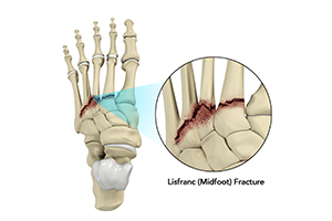 Lisfranc (Midfoot) Fracture Icon