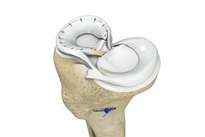 Meniscal Repair Surgery Icon