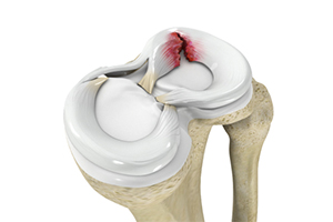 Meniscal Tears Icon