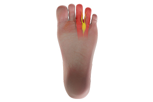 Morton's Neuroma Icon