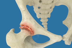 Osteoarthritis of the Hip Icon
