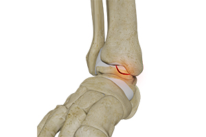 Osteochondral Lesions of the Ankle Icon