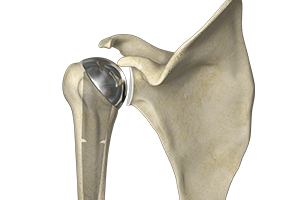 Partial Shoulder Replacement Icon